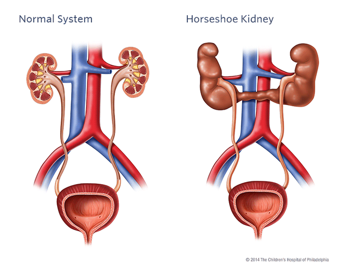 Horseshoe Kidney illustration Children's Hospital of Philadelphia