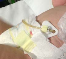 Gastrostomy